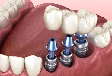 implants